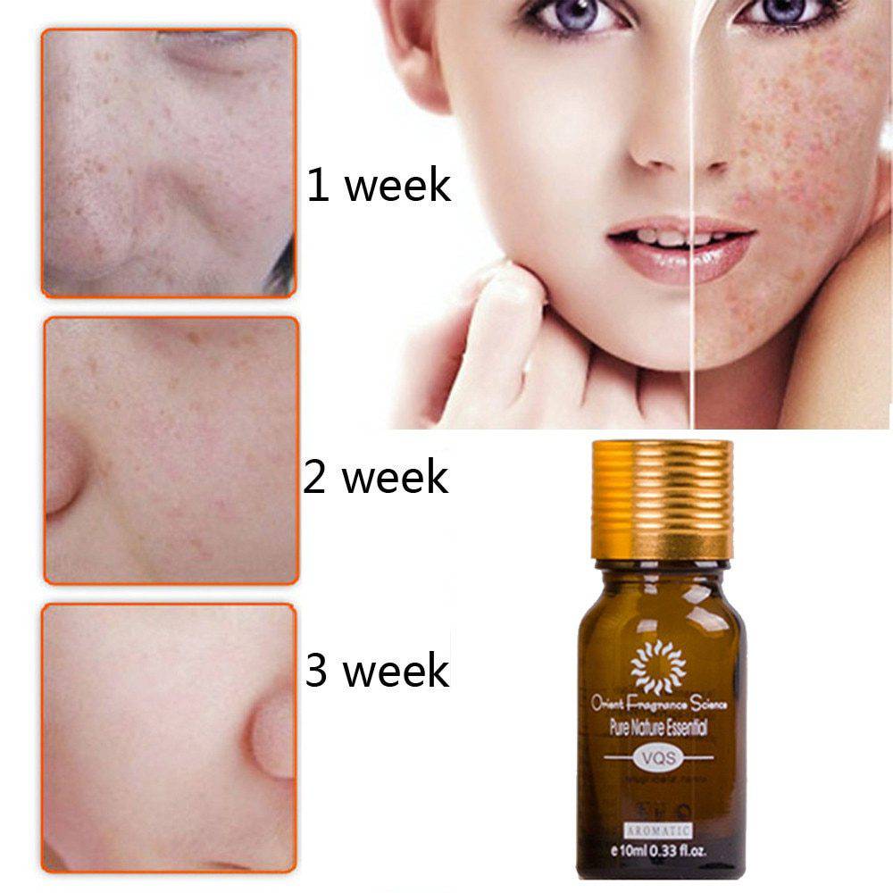 Dredge Meridian Skin Care Natural Pure Removal Acne Stretch Marks Scar Removal Essence oil - YLORESHOP