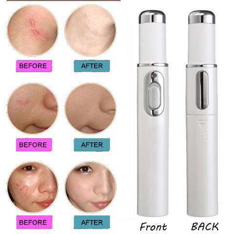 Blue Light Therapy Acne Laser Pen Soft Scar Wrinkle Removal Treatment Device Skin Care Beauty Equipment - YLORESHOP